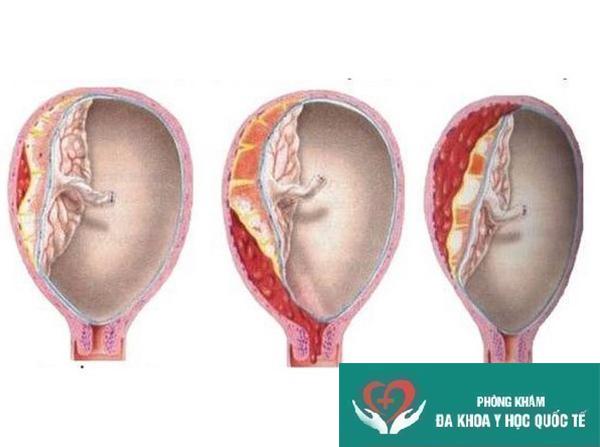 Bóc tách túi thai khi mang bầu có nguy hiểm không