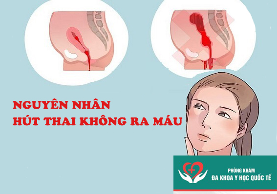Nguyên nhân hút thai không ra máu?